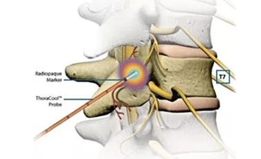 Facet Joint Radio Frequency Neurotomy – Alliance Spine Associates